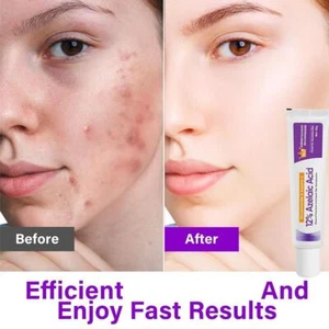 Azelaic Azelaic 12% Facial y Para Enrojecimiento Exceso Oscuro 20 ml Limpieza de Sebo B8J3 - Imagen 1 de 9