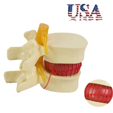 Anatomical Spine Lumbar Disc Models Herniation Anatomy Medical Teaching Supplies