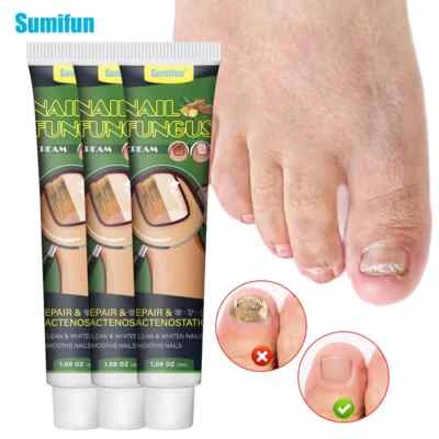 SUMIFUN New 30g Nail Fungus Cream Treat Onychomycosis Finger Toe Paronychia Ointment