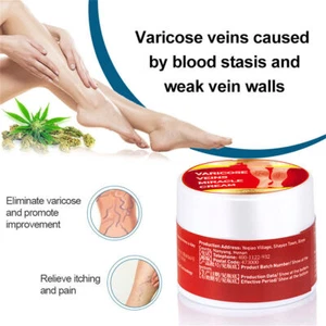 Varicose Veins Miracle Cream Vasculitis Legs Treatment External Skin Ointment - Picture 1 of 6