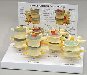 Lumbar Vertebrae Set, Herniated,Anatomical Model, Spine - Picture 1 of 1