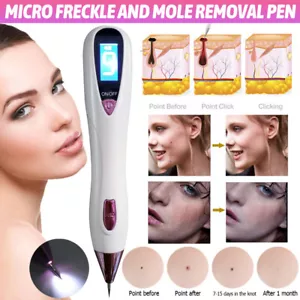 Electrico Laser Verrugas Quita Entferner Stift Para Mezquinos Elimina Pecas Maquina - Bild 1 von 27
