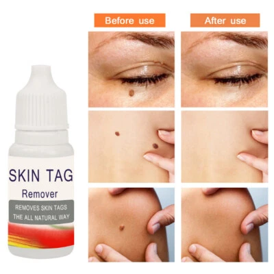 Rimozione Verruche Trattamento Pelle Giorno Rimuovi Verruche Skin Mole 10ML - Immagine 1 di 4