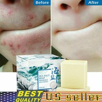 acne care soap watsons