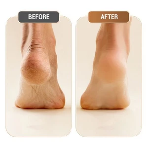 Electric Foot Callus Remover Scrubber High Low Speed Pedicure Kit USB Foot - Picture 1 of 28