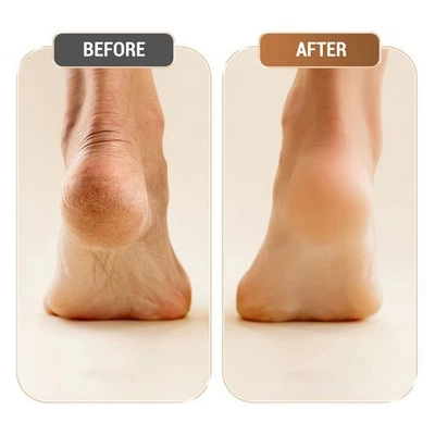 Electric Foot Callus Remover Scrubber High Low Speed Pedicure Kit USB Foot - Image 1 of 4