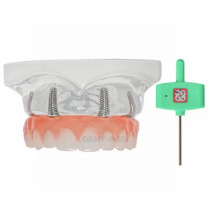 Implante Dental Dientes Modelo Mandíbula Superior 4 Tornillos con Poste Núcleo Puentes Restauración - Imagen 1 de 9