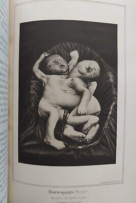 Rare Early Medical Pathology Methods Freaks Oddities Siamese Twins Book Surgery • 32.19$
