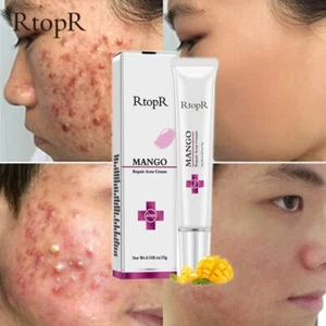Crème de traitement pour l'acné sur le visage, cosmétiques, soins - Picture 1 of 6