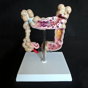 Anatomical Human Colon Pathological Diseases Model - Medical Anatomy - Picture 1 of 4