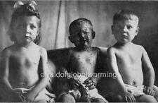 Old Photo.  Smallpox - 3 Siblings Brought to Hospital - 1 Unvaccinated