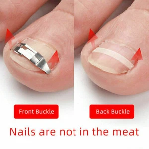 4 Nagelspange Eingewachsene Zehennagel Korrektur Nagel Fixer Pediküre Fuß-Pflege - Bild 1 von 8