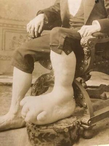 Rare Medical & Anatomical Curiosity "Ohio Big Foot Boy" Antique Photo Oddities - Picture 1 of 3