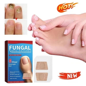 Pilz Nagelpflaster | 8 Stunden schnelle Regeneration | Behandlung von Nagelpilz - Bild 1 von 13