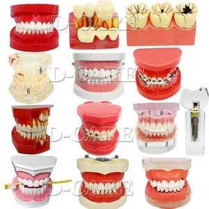 Dental Orthodontics Implant Study Model Analysis Demonstration Tooth Teaching - Picture 1 of 158