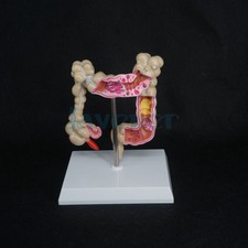 Anatomical Human Colon Intestine Pathological Diseases Model Medical Anatomy