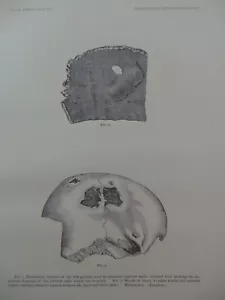 1882 CRANIAL AMULETS Skull Prehistoric Trephining Trepanning Crania Fracture - Picture 1 of 2