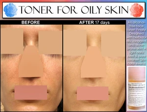 2 Before and After pics Best Natural Alcohol Free Face Toner For Oily Skin AHA's - Picture 1 of 4