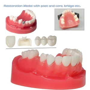 Upper Jaw with Removable Ceramic Restorations Implant Model Crown Bridge Demo - Picture 1 of 13