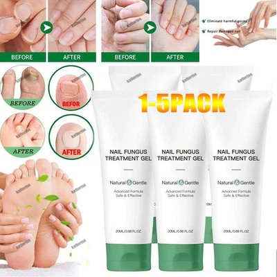 5X Gel de tratamiento de hongos en uñas Nutraboost, hongos en uñas, crema de hongos EE. UU. (-20% DE DESCUENTO) Foto 1 de 4