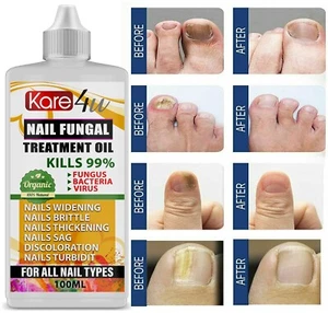 MEJOR tratamiento micótico de uñas - Detiene infecciones por uñas de los pies, dedos y hongos Reino Unido 100 ml - Imagen 1 de 1
