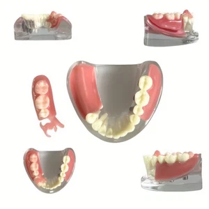 Comparación de restauración de implantes dentales modelo de prótesis de corona y puente - Imagen 1 de 15