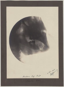 Dated 1924 x-ray of a throat, signed French photo - Picture 1 of 1