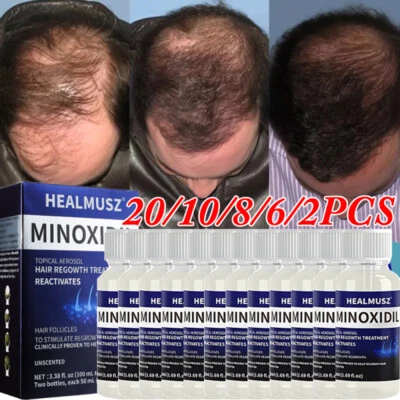 Minoxidil 5% Topical Solution for Men Hair Regrowth, Anti Hair Loss Treatment US - Image 1 of 4