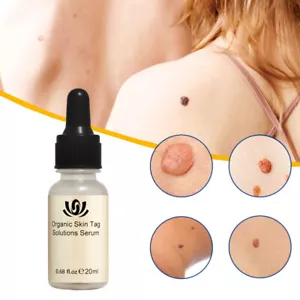 12 Hours Wart Remover Skin Tags Mole Remover Eliminate Foot Corn Wart . - Picture 1 of 12