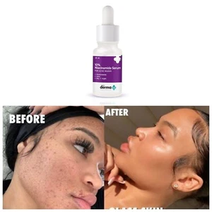 The Derma Co 10% Niacinamide Face Serum 10ml For Acne Marks & Acne Prone Skin - Picture 1 of 5