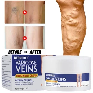 Varicose Veins Treatment Cream Vasculitis Phlebitis Spider Relief Pain Ointment - Picture 1 of 27