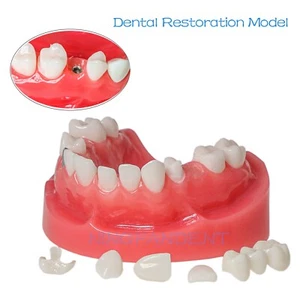 Modelo de restauración de implantes tipodontes dentales poste de demostración núcleo puente dientes de cerámica - Imagen 1 de 11