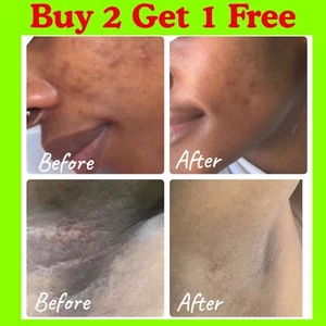 Dark Skin Bleaching Cream Whitening Lightening Dark Spot Max Strength SERUM  - Picture 1 of 11