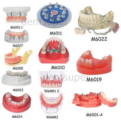 Modelo de restauración de corona dental demostración con dentadura parcial molde dental Cov Foto 1 de 4