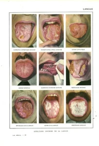 Cabinet de curiosité anatomie humaine affections langue issue du livre - Picture 1 of 1