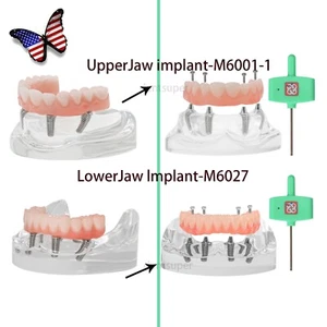 US Dental Upper/Lower 4 Implants Demo Teeth Model - Restoration Overdenture - Picture 1 of 47