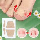 Nail Care Patch Ingrown Toenail Pad Orthopedic Patch Soft Nail Repair Patch