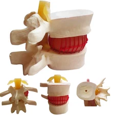 Carejoy Spine Lumbar Disc Herniation Model Demonstration Medical Model