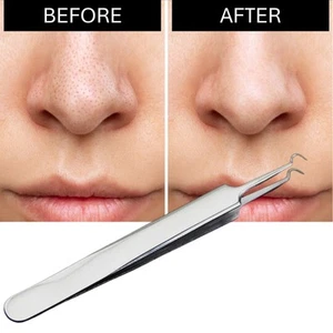Blackhead Remover Tool UK – Stainless Steel Curved Acne Tweezer Clip - Picture 1 of 11