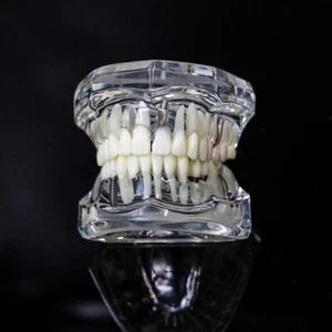 Modelo Dental Dientes Implante Restauración Puente Enseñanza Estudio Dentista Odontología - Imagen 1 de 6