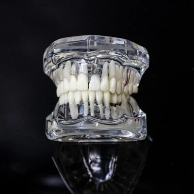 Modelo Dental Dientes Implante Restauración Puente Enseñanza Estudio Dentista Odontología Foto 1 de 4