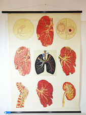 Vintage Karta rolkowa Gruźlica Płuca Medyczna Karta ścienna Dekoracja