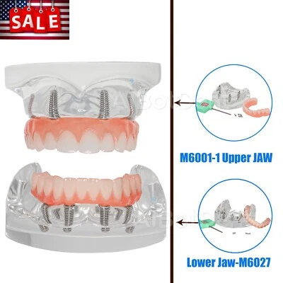 США All-on-4 имплантат модель набор прозрачный верхняя/нижняя челюсть с 4 винтами съемные зубы - Изображение 1 из 4