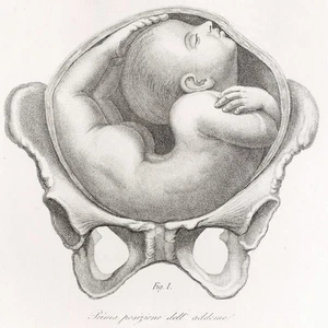 1841 Magnificent Giovanni Raffaele Large Folio Obstetric Engraving, Pl. 53 - Picture 1 of 7