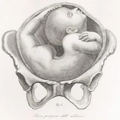 1841 Magnificent Giovanni Raffaele Large Folio Obstetric Engraving, Pl. 53 - Image 1 of 4