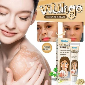 Vitiligo Removal Cream Natural White Spot Treatment Fast 2025 Acting U1C3 - Picture 1 of 21