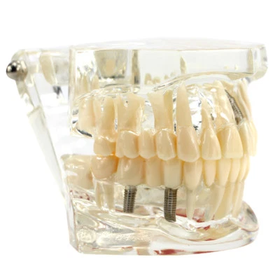 Modelo de Implante Dental y Restauración Dientes Patológicos Transparentes Modelo de Estudio Foto 1 de 4