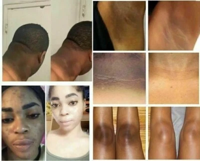 HEALTH VIT Dark Skin Bleaching Cream Lightening Whitening for Face & Body - 15 gm Free Ship