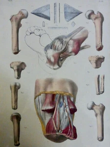1850 Anatomy Surgery Amputations Cured 1 Lithograph - Picture 1 of 3
