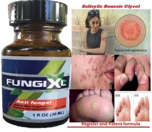 Athlete's Foot Antifungal Support Jock Itch Ringworm Itching Anti Fungus - Picture 1 of 6